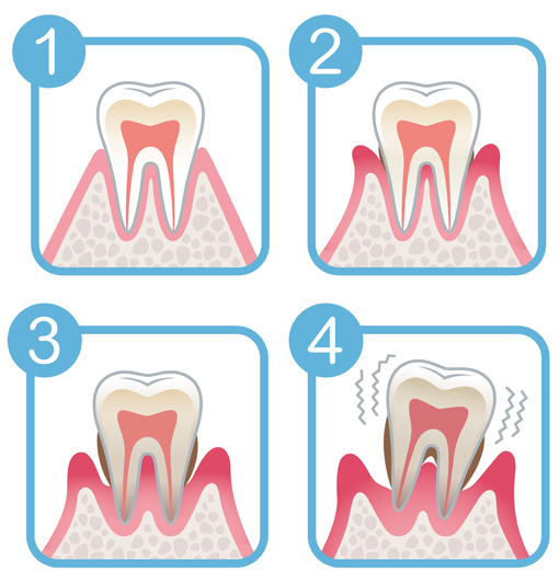 img-parodontologia-studio-dentistico-porcari