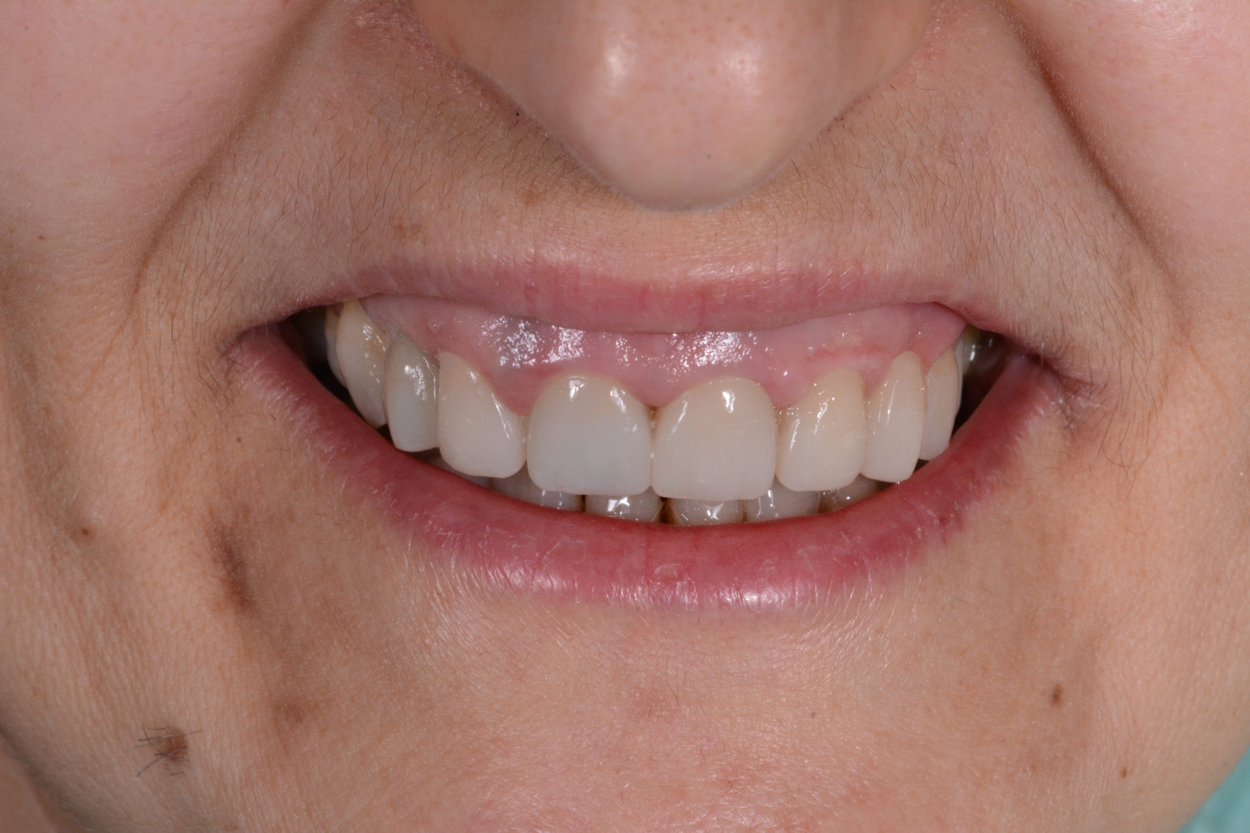 La ricostruzione in pochi e non dolorosi passaggi del sorriso di un paziente tramite le tecnologia all’avanguardia utilizzate dallo Studio dentistico Porcari.