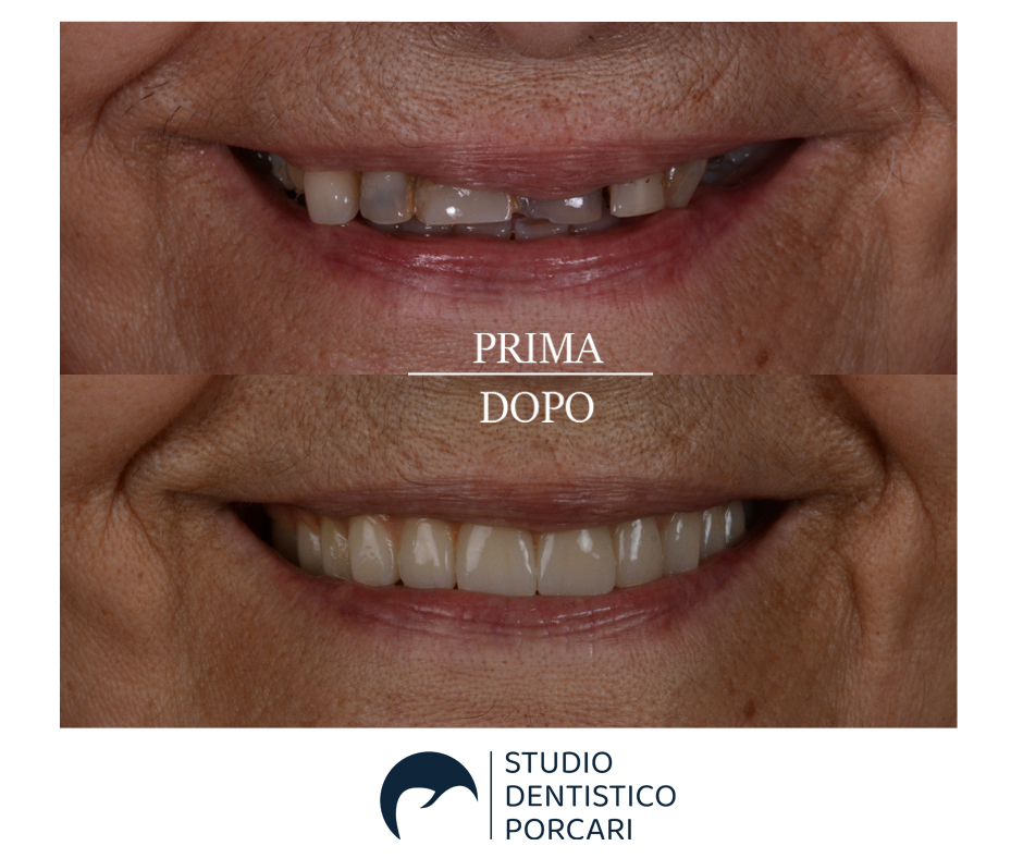 La ricostruzione in pochi e non dolorosi passaggi del sorriso di un paziente tramite le tecnologia all’avanguardia utilizzate dallo Studio dentistico Porcari.