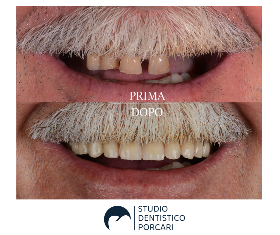 La ricostruzione in pochi e non dolorosi passaggi del sorriso di un paziente tramite le tecnologia all’avanguardia utilizzate dallo Studio dentistico Porcari.